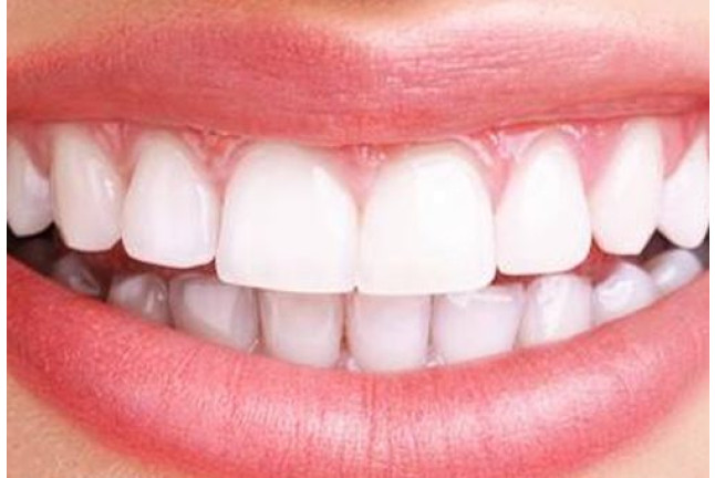 Blanqueamiento Dental LED con Limpieza Bucal en BeYourself (Madrid)