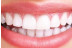 Blanqueamiento Dental LED con Limpieza Bucal en BeYourself (Madrid)
